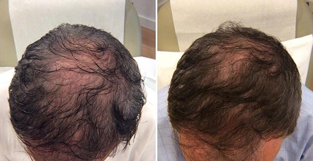 Hair Restoration treatment