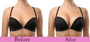 Breast Enlargement