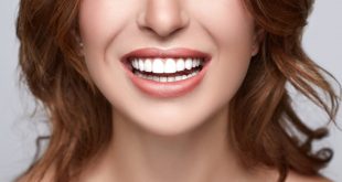 Porcelain veneers