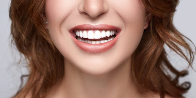 Porcelain veneers
