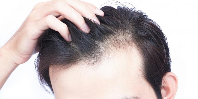 Mature Hairline