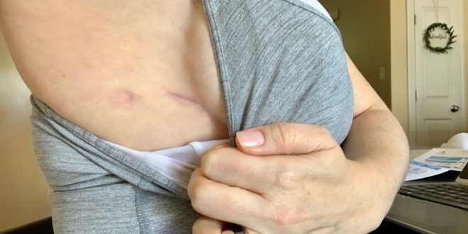 Prophylactic mastectomy