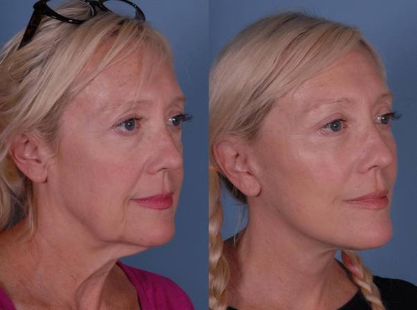 face lift surgery in Santa Monica