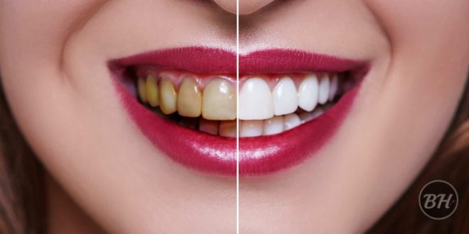 At-Home Teeth Whitening Kit