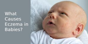 What Causes Eczema in Babies?