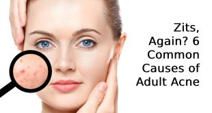 Common Causes of Adult Acne