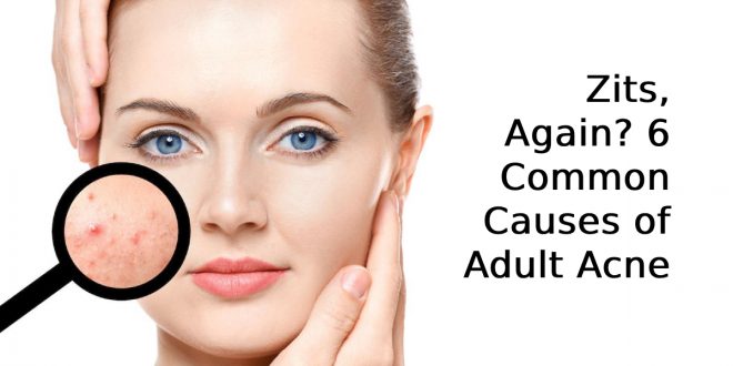 Common Causes of Adult Acne