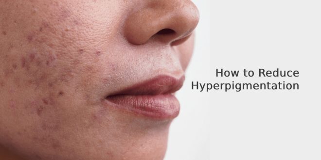 How to Reduce Hyperpigmentation