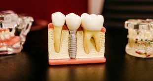 Root Canal Treatment