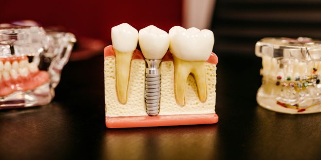 Root Canal Treatment