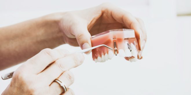 dental implant