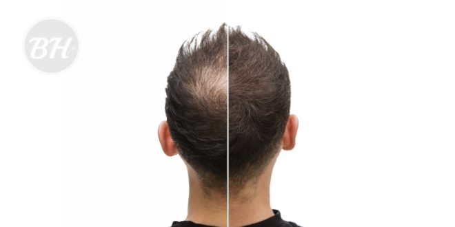 Scalp Micropigmentation