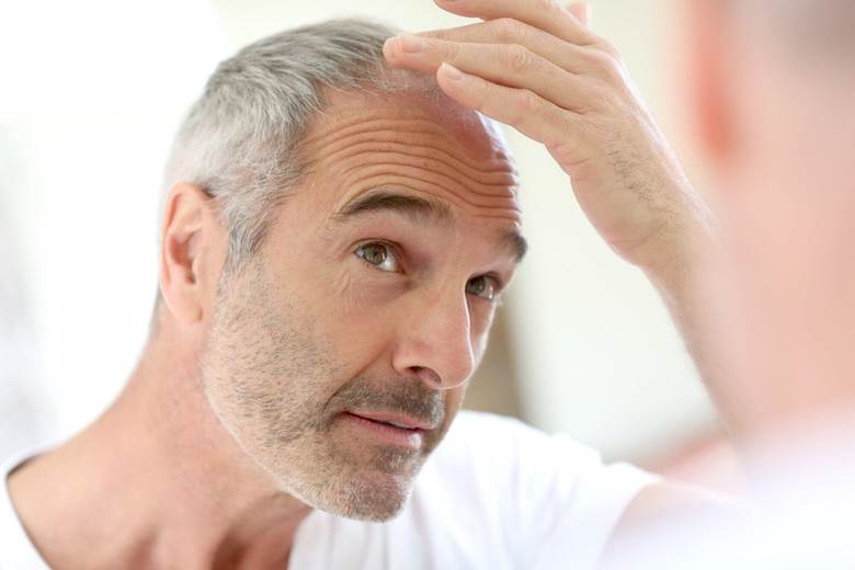 Scalp Micropigmentation