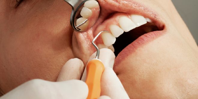 Manhattan porcelain veneers