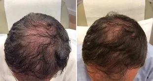 Hair Restoration treatment