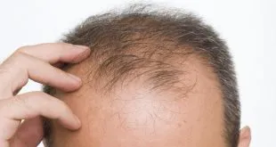 hair loss