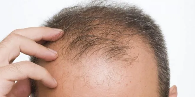 hair loss