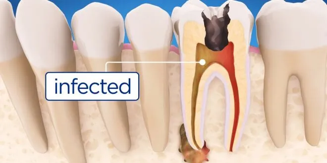 root canal treatment