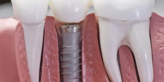 Dental Implants