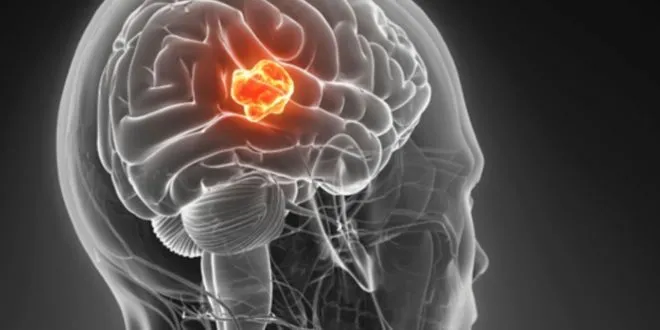 Treatment For a Skull Tumor
