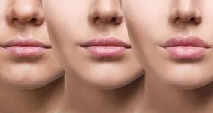 Lip Augmentation