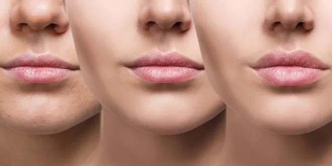 Lip Augmentation