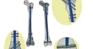 intramedullary nail