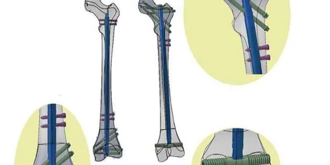 intramedullary nail