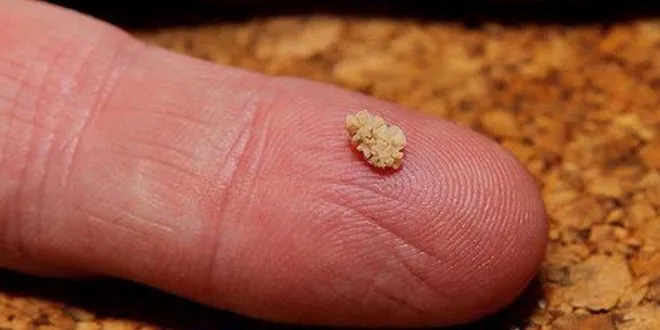 kidney stone treatment