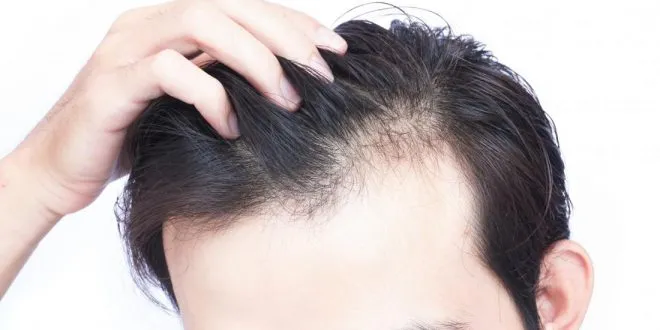Mature Hairline
