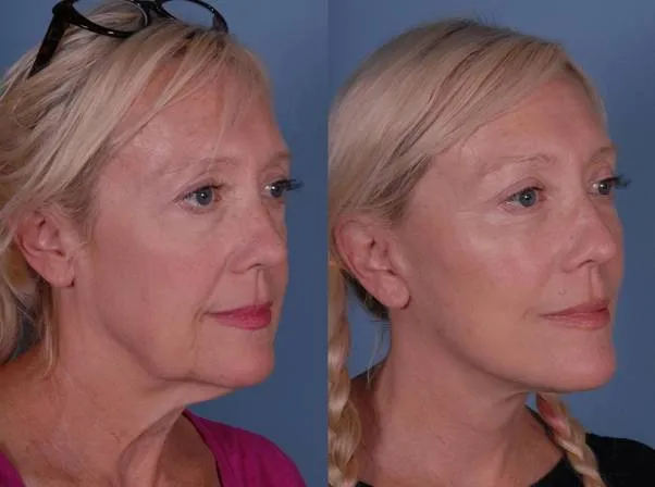 face lift surgery in Santa Monica