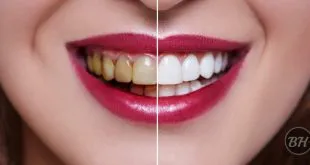 At-Home Teeth Whitening Kit