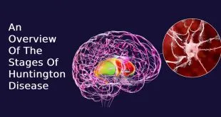 An Overview Of The Stages Of Huntington Disease