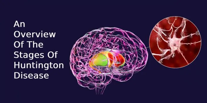 An Overview Of The Stages Of Huntington Disease