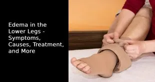 Edema in the Lower Legs