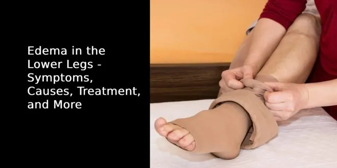 Edema in the Lower Legs