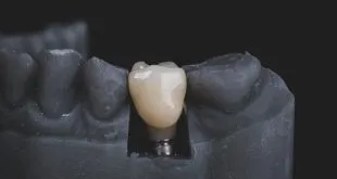 dental implant