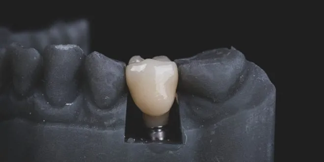dental implant