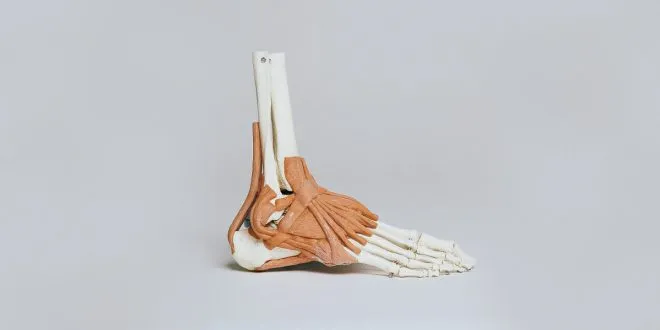 Bunion Treatment