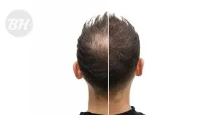 Scalp Micropigmentation