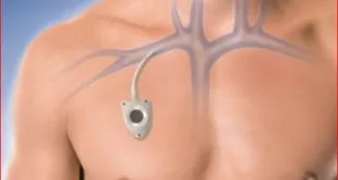 Implanted Catheter