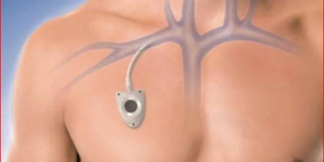 Implanted Catheter