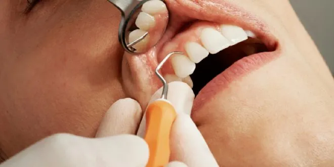 Manhattan porcelain veneers