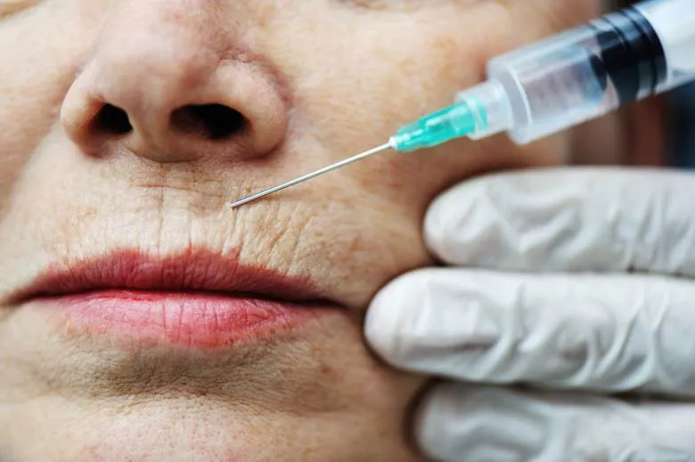 Microneedling