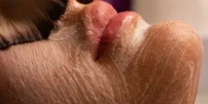 Home Remedies For Pimples