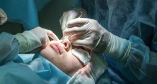 LASIK Surgery