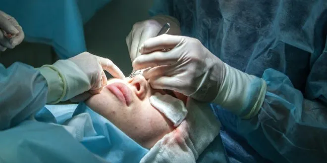 LASIK Surgery